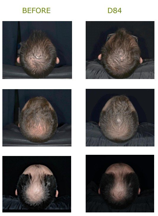 Hair-growth formula before and Day 84 density comparison